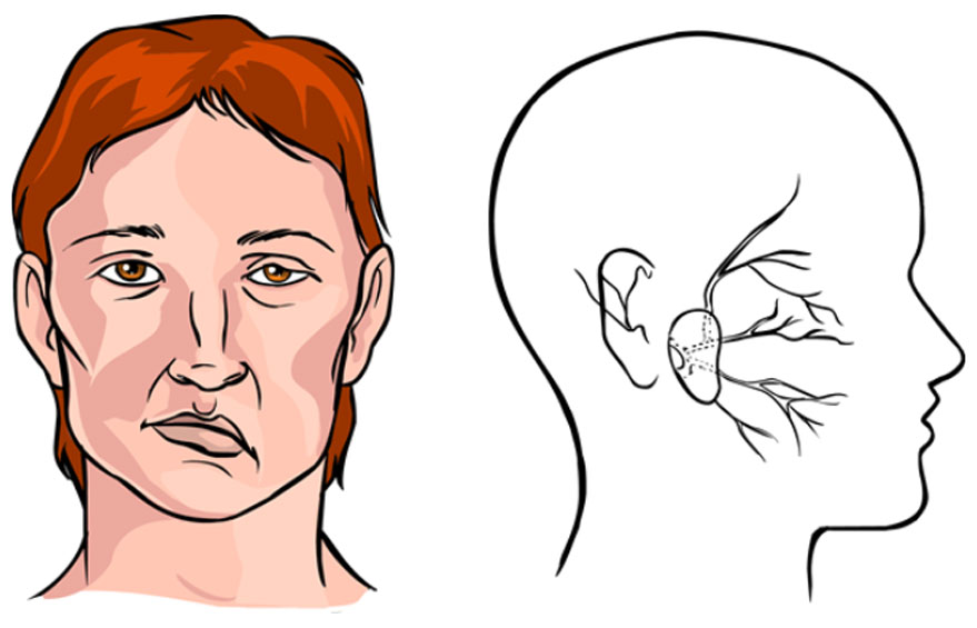 Chấn thương thần kinh ngoại biên - Hình ảnh minh họa